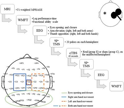 The Role of Continuous Theta Burst TMS in the Neurorehabilitation of Subacute Stroke Patients: A Placebo-Controlled Study